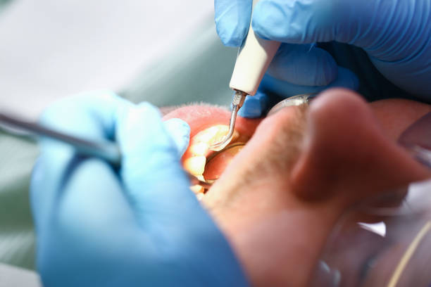 Best Broken or Chipped Tooth Repair in Underwood, IA